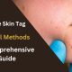 Effective Skin Tag Removal Methods