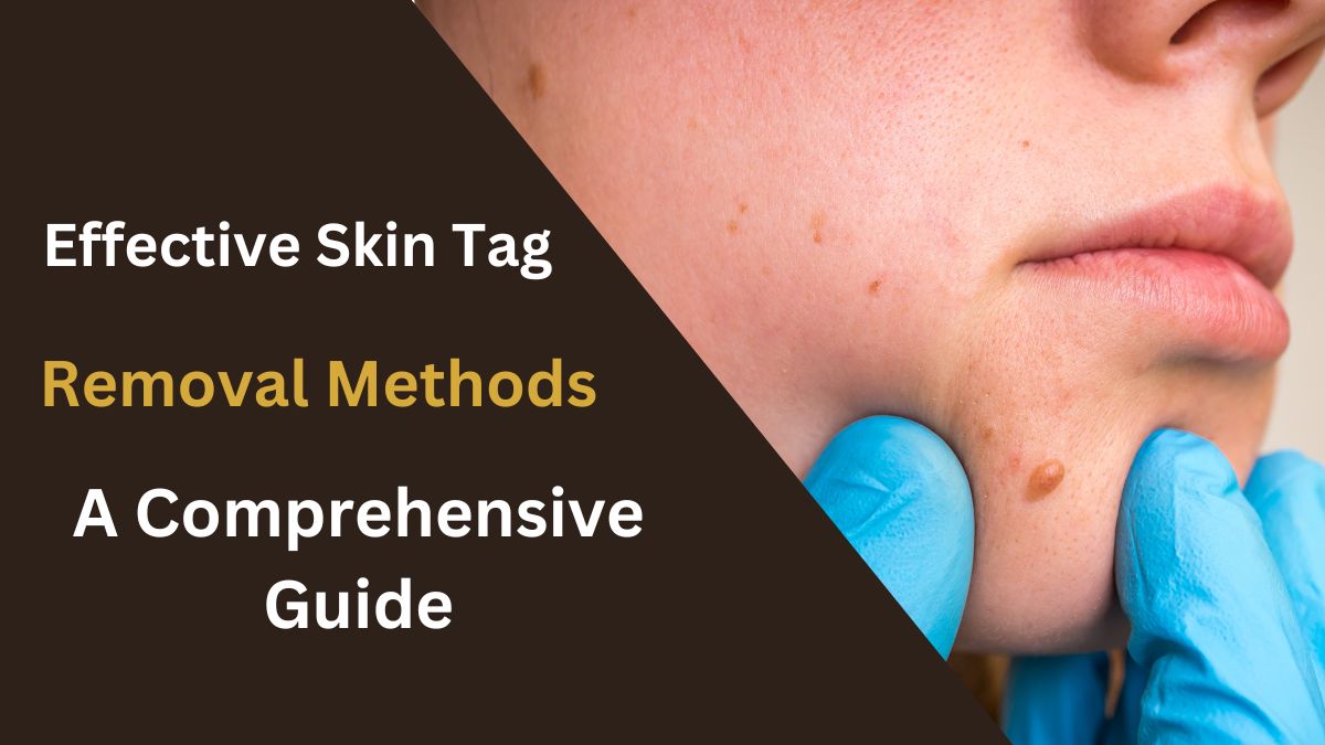 Effective Skin Tag Removal Methods