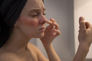 A woman having skin irritation due to salicylic acid